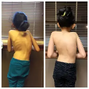 Before and after photos showing significant physical improvement in a young boy's back and posture.