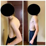 Side-by-side comparison of posture improvement in a young person.