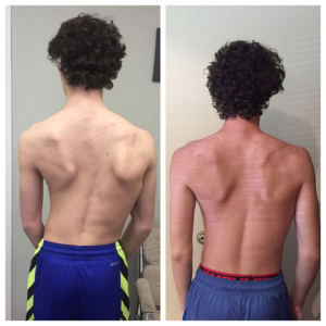 scoliosis and spine curve correction | Ellen Condren, Cleveland, Ohio