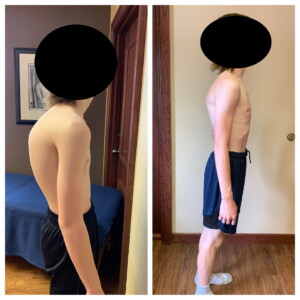 Scoliosis & Kyphosis - image 2