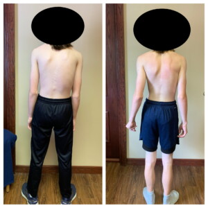 Scoliosis & Kyphosis - image 3